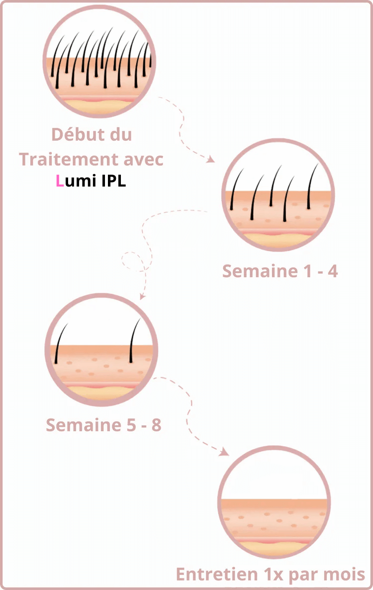 Épilateur lumière pulsée épilations définitives-resultat-lumiwomen